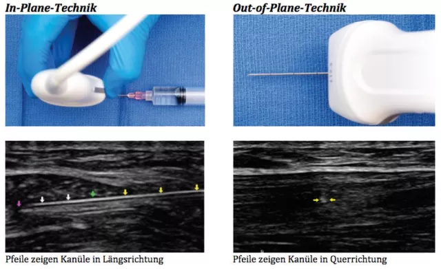 Bild: Ultraschall gesteuerte Injektions-Techniken in der Orthopädie
