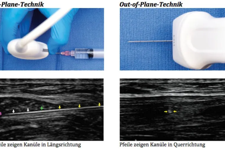 Bild: Ultraschall gesteuerte Injektions-Techniken in der Orthopädie