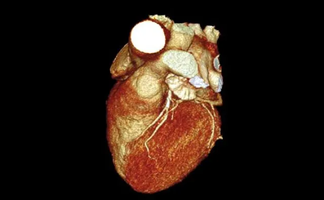 Bild: Diagnostische Revolution der Computertomografie für Herzkranke in Hamburg