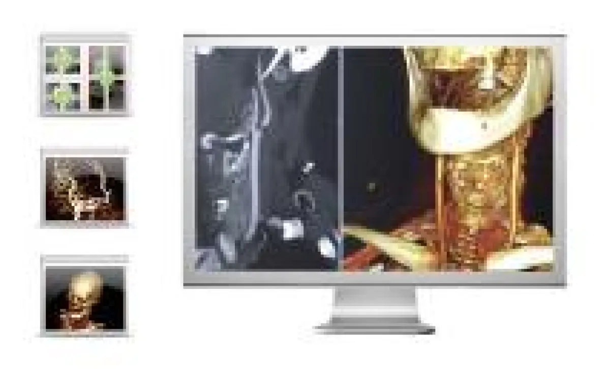 Postprocessing mit OsiriX PRO
