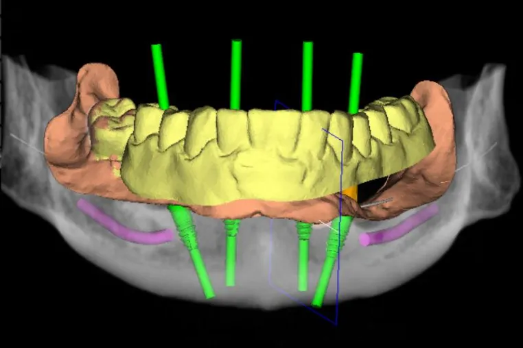 Bild: Planung von Implantaten mit dem DVT
