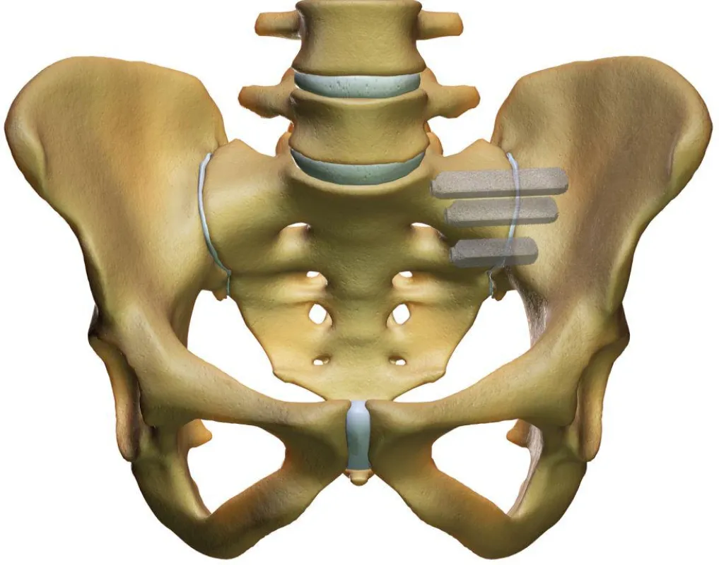 iFuse Implantate im Iliosakralgelenk