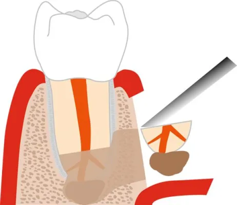 Bild: Bei entzündeter Zahnwurzel ist Zahnerhalt oberstes Gebot