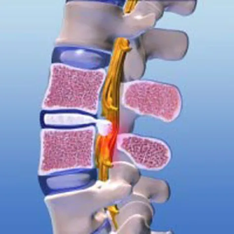 Bild: Minimalinvasive Bandscheibenoperation - eine Erfolgsgeschichte