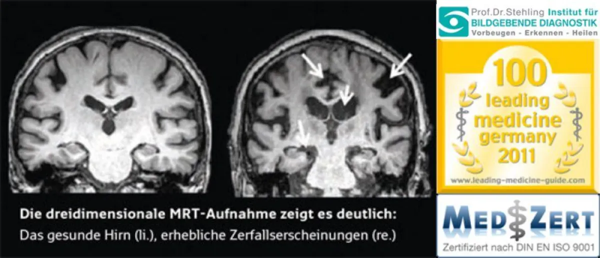 Alzheimer-Vorsorge zahlt sich aus