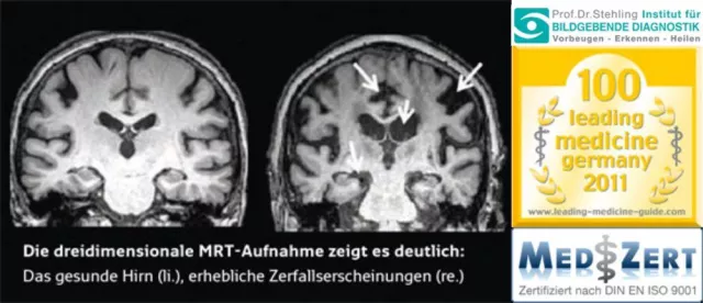 Bild: Alzheimer, Demenz und andere neurodegenerative Erkrankungen: Vorsorge zahlt sich aus
