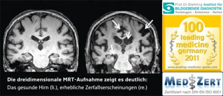 Bild: Alzheimer, Demenz und andere neurodegenerative Erkrankungen: Vorsorge zahlt sich aus