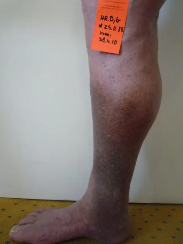 Thrombosespätschaden nach Oberschenkelthrombose