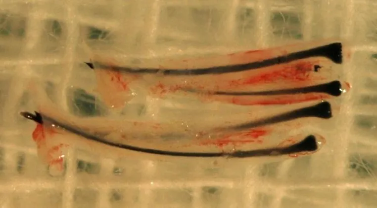 Bild: Haartransplantation
