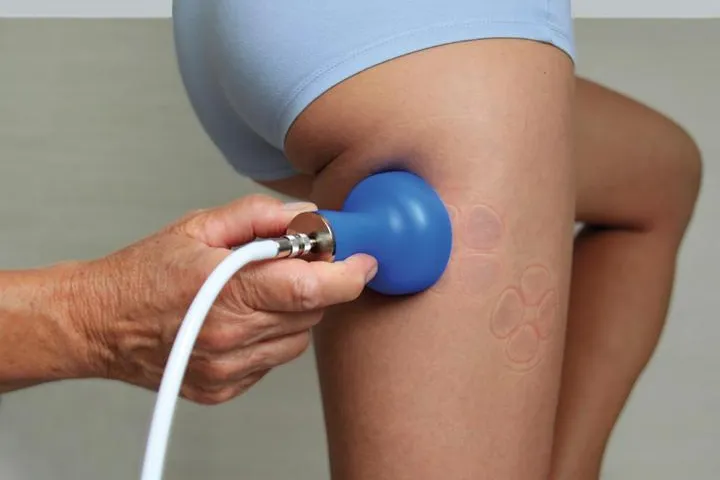 Das Ziel war der Anfang - Vacuum-Massage von Bamberger Bild: Das Ziel war der Anfang - Vacuum-Massage von Bamberger