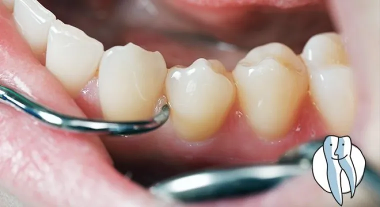 Bild: Zahnfleischbluten