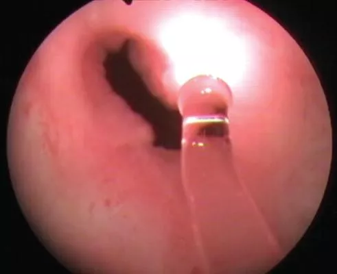 Bild: Forschungsvorhaben der Charité & Limmer Laser GmbH erhält Auszeichnung des BMWi