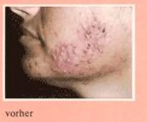 Bild: Die erfolgreiche Behandlung der Akne