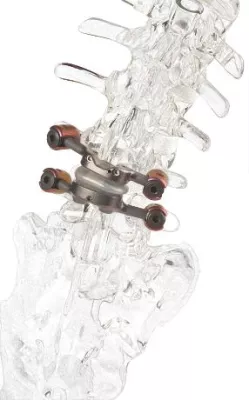 Bild: Gute Nachricht bei Spinalkanalstenose: Schmerzfreiheit & Beweglichkeit dank neuer OP-Methode