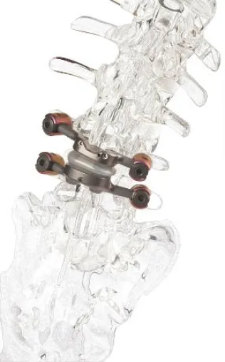 Bild: Gute Nachricht bei Spinalkanalstenose: Schmerzfreiheit & Beweglichkeit dank neuer OP-Methode
