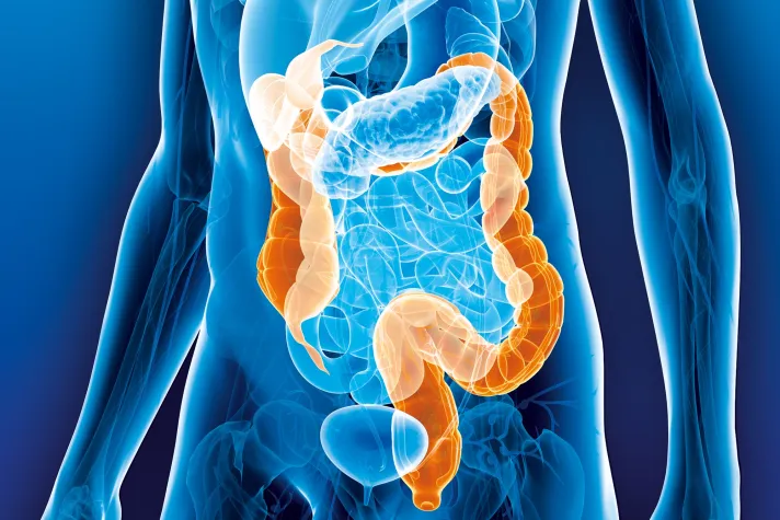 Bild: Darmkrebs: Frauen und Männer erkranken unterschiedlich