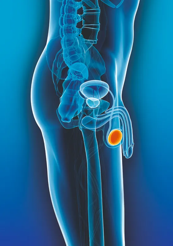 Tumor am Hoden (© Deutsche Krebshilfe)