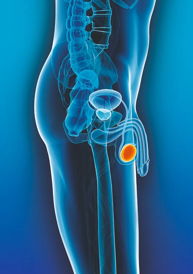 Tumor am Hoden (© Deutsche Krebshilfe)