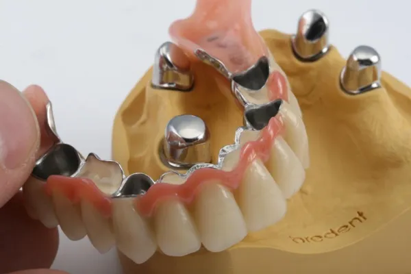 Rationelle und individuelle Verblendtechnik: Zahntechniker, Implantologen und Patienten überzeugt Bild: Rationelle und individuelle Verblendtechnik: Zahntechniker, Implantologen und Patienten überzeugt