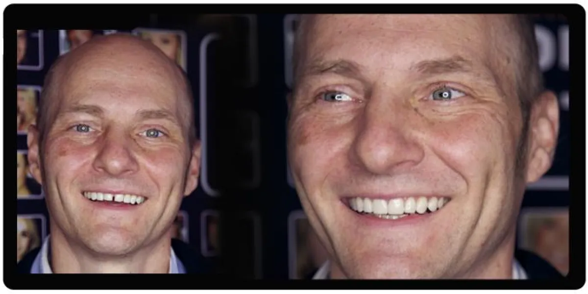 Der Patient fühlte sich der Lücke zwischen den Schneidezähnen nicht wohl.