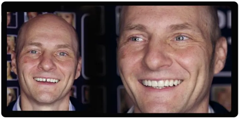 Bild: TESTENEERS® - Verliebe Dich in Dein Lächeln