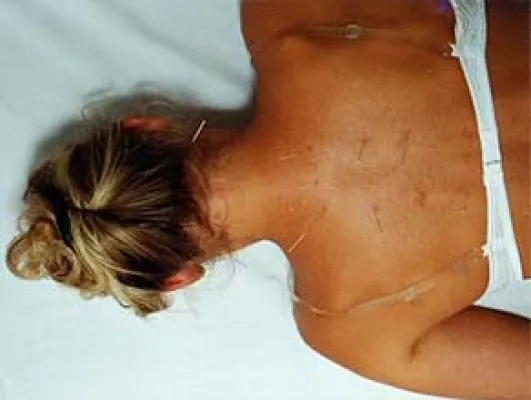 Akupunktur: Wie tausend Nadelstiche helfen Bild: Akupunktur: Wie tausend Nadelstiche helfen