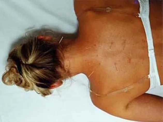 Bild: Akupunktur: Wie tausend Nadelstiche helfen