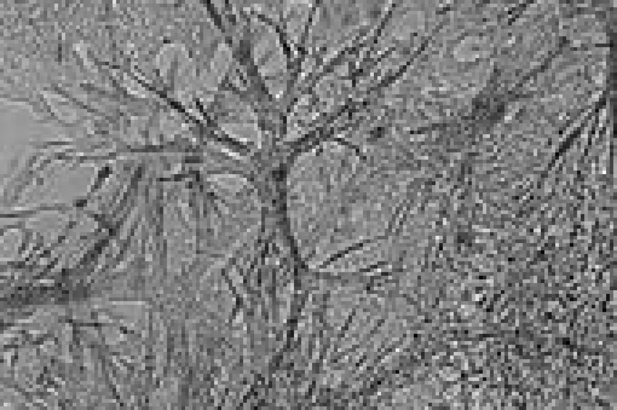 Metastastische Leberkrebszellen in einer 3-dimensionalen Gelmatrix.