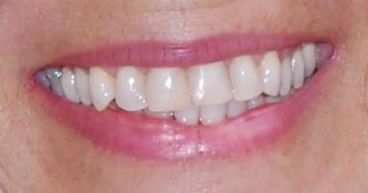 Zahngesundheit ohne Amalgam