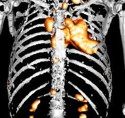 Bild: Teilnahme am 2. Kölner Krebstag - Neue PET/CT Kooperation mit der Techniker Krankenkasse