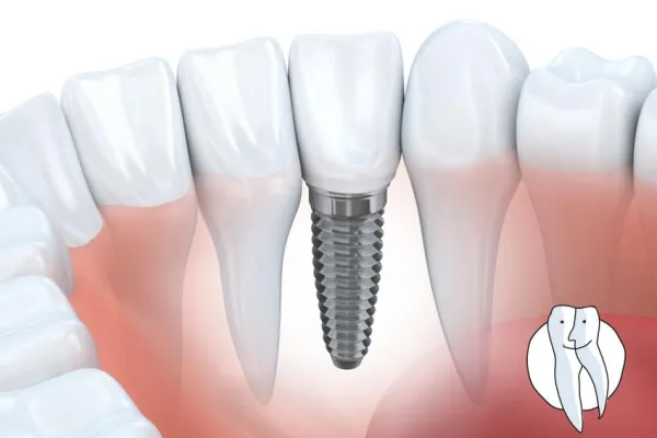 Bild: Diagnosekaugummi bei Implantaten?