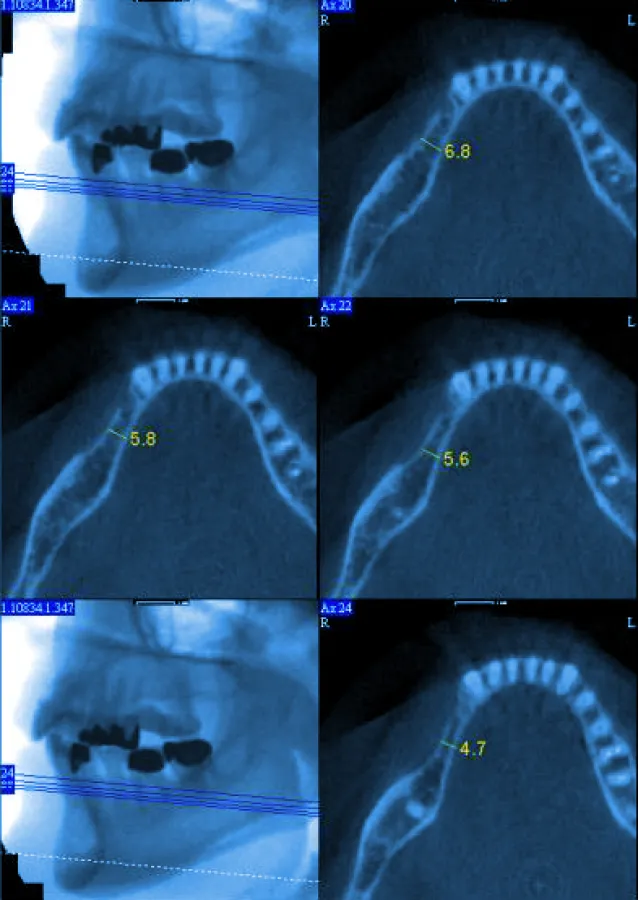 Volumentompgraphie 3D Modell eines Kiefers