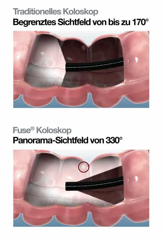 Vergleich des Fuse®-Systems (unten) mit einem herkömmlichen Endoskop (oben)