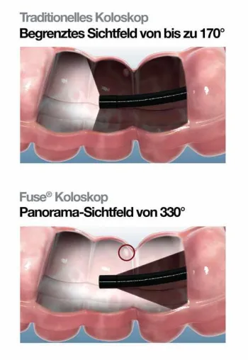 Rundumsicht im Darm Bild: Rundumsicht im Darm