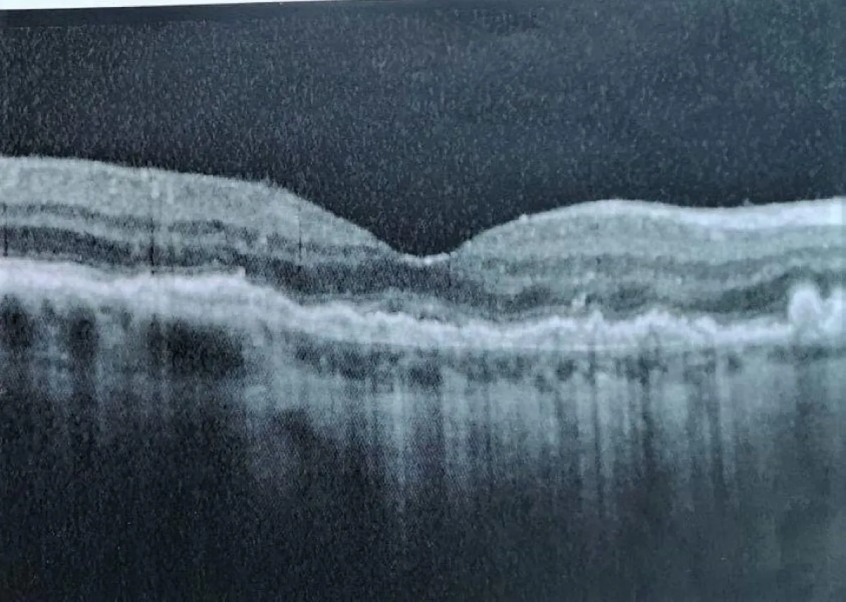 Scan der Netzhaut, die sich nach 4 Wochen Akupunkturbehandlung regeneriert hat.
