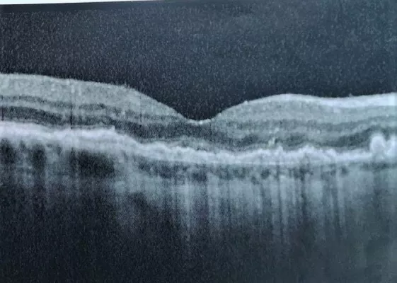 Bild: Besser sehen: Moderne Akupunktur nach Boel erfolgreich bei AMD