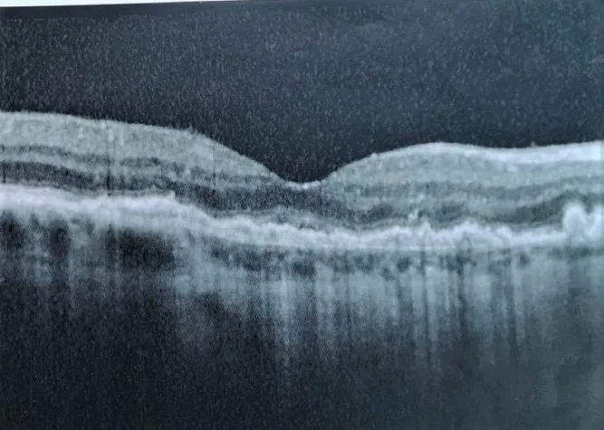 Bild: Besser sehen: Moderne Akupunktur nach Boel erfolgreich bei AMD
