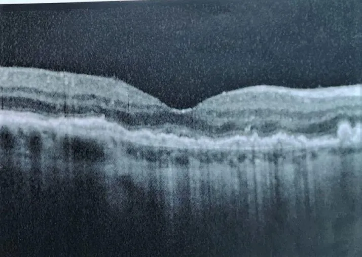 Bild: Besser sehen: Moderne Akupunktur nach Boel erfolgreich bei AMD