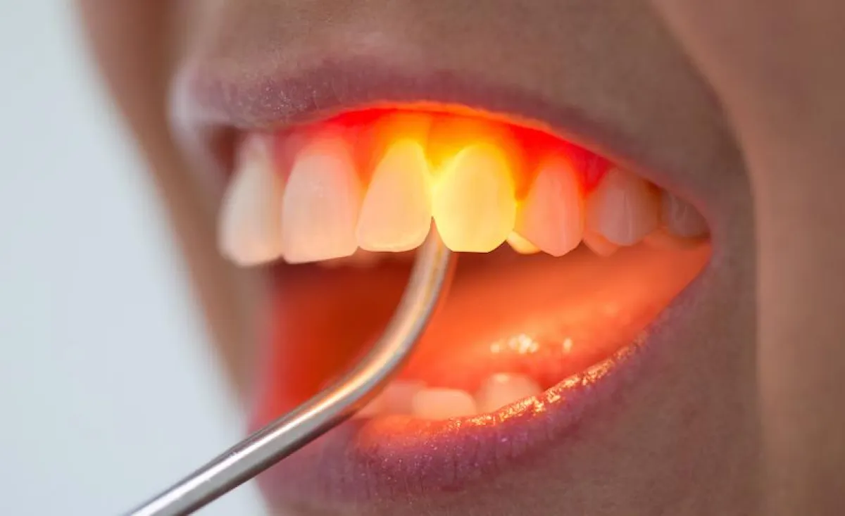 Zahnfleischlifting: schnelle Abhilfe nach Parodontitis