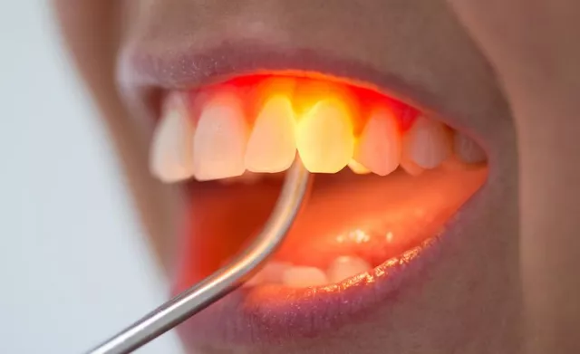 Bild: Zahnfleischlifting für Fortgeschrittene - jetzt in München