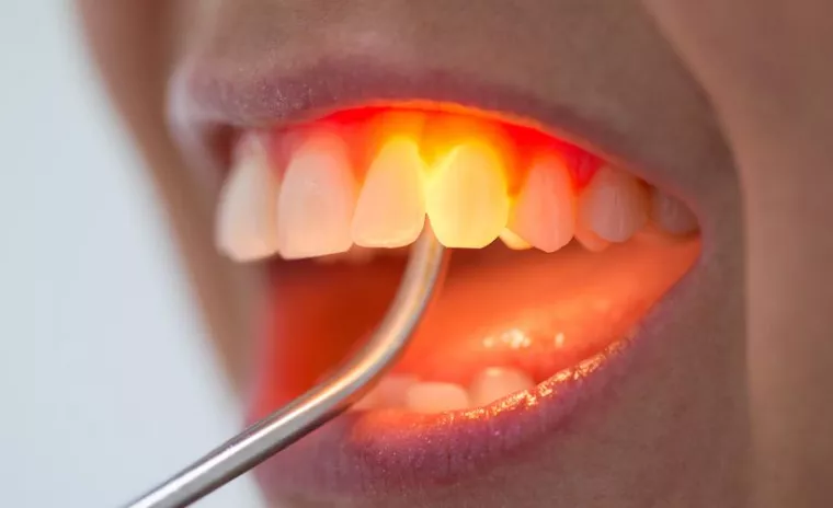 Bild: Zahnfleischlifting für Fortgeschrittene - jetzt in München