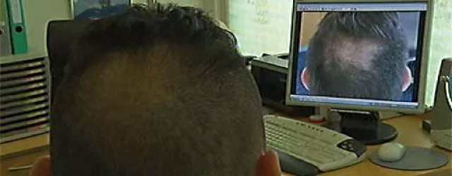 Bild: Mit Botox gegen Haarausfall - Die AC-Therapie