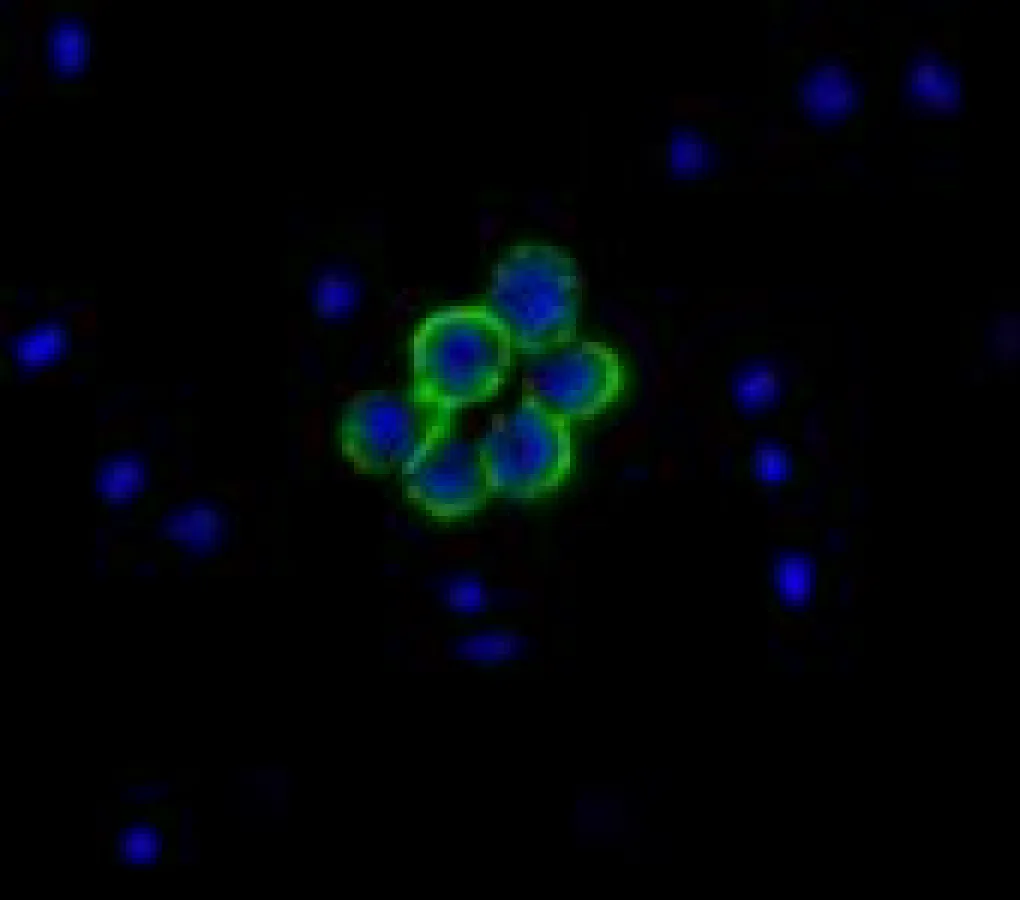 Identische Zellstrukturen können bei verschiedenen Krebsarten unterschiedliche Funktionen erfüllen. Eine aktuelle Studie im British Journal of Cancer zeigt dies für ein therapeutisch wichtiges Rezepto
