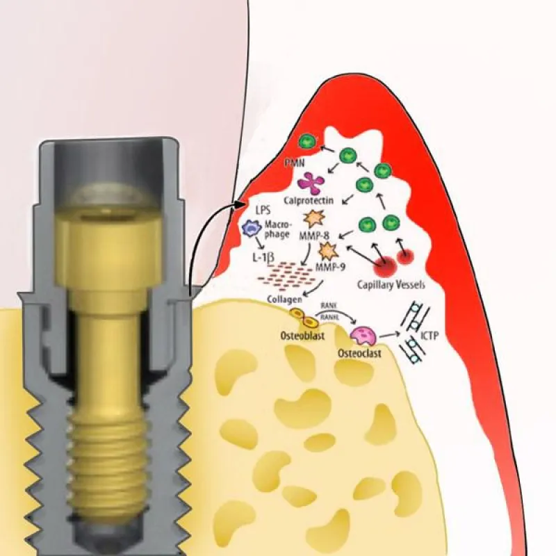 Periimplantitis assoziierte Bakterien vermehren sich schnell im feuchtwarmen Milieu der innenligende