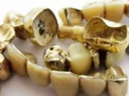 Bild: Bruchgold, Zahngold, jeder hat etwas davon zuhause rumliegen. Wir zahlen bares Geld dafür, jetzt auch on