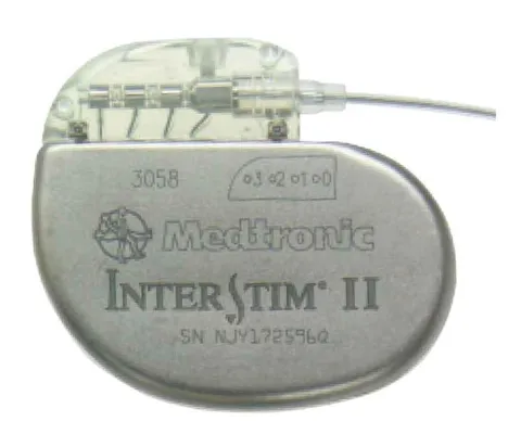 Erster Schrittmacher für (Stuhl-) Inkontinenz in Hamburg Bild: Erster Schrittmacher für (Stuhl-) Inkontinenz in Hamburg