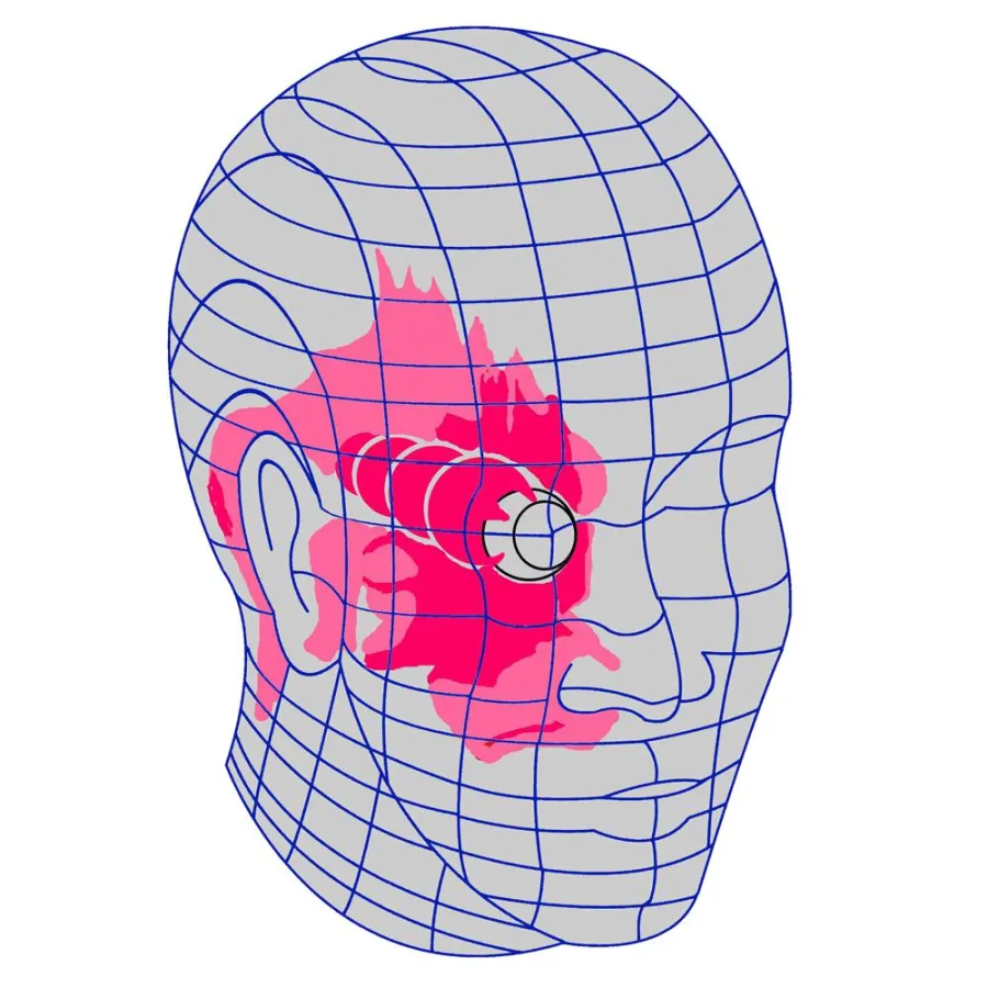 Bundesverband der Clusterkopfschmerz-Selbsthilfe-Gruppen (CSG) e.V.