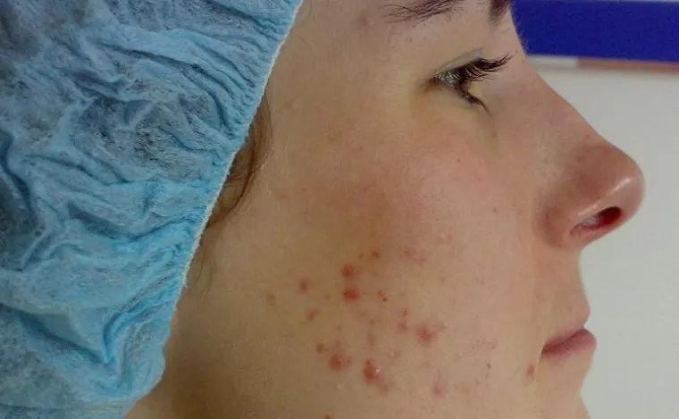 Bild: Hautstudie zur Behandlung von Akne