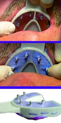 Bild: 95 % der Zahnmediziner bewerten Miratray Implant als empfehlenswert