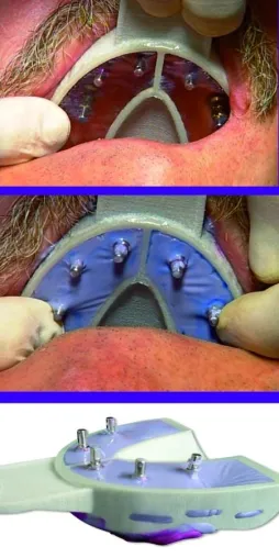 Bild: 95 % der Zahnmediziner bewerten Miratray Implant als empfehlenswert